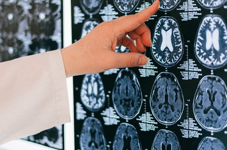 Hirnstimulation